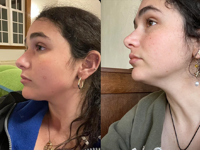 Fixed receding chin picture of before and after mewing